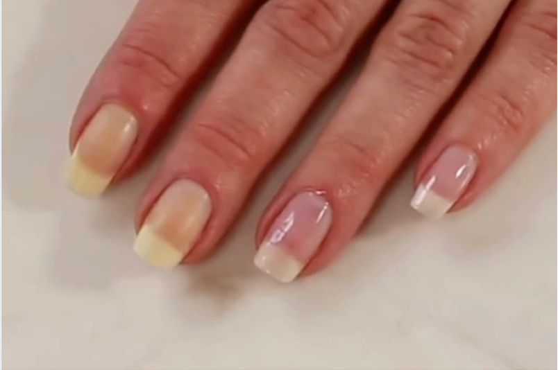 Close-up of a hand showing a transformation using Perfect Formula Pink Gel Coat, with three nails having a yellowish stained base and one nail showing a clean, glossy white tip.